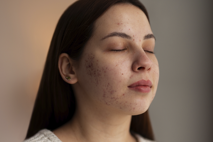 Acne-Prone Skin and Blemish Control Skincare Routine